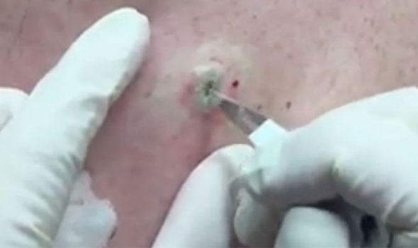 Watch When A Man Has Huge Blackhead Removed By Dr Pimple Popper