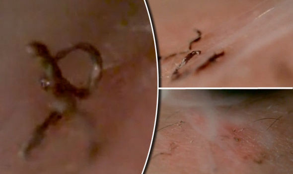 This Is What Really Happens To Your Skin During Laser Hair Removal