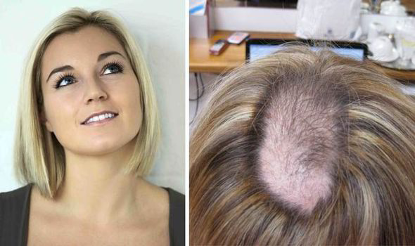 Trichotillomania Sufferer Katie Neiman On Her Hair Pulling