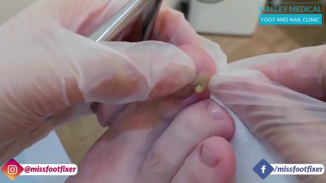 Foot Fixer Surgeon Removes Ingrown Nail From Puss Filled Toe
