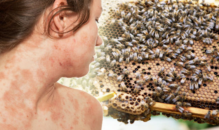 Homemade Scalp Treatment For Eczema - Homemade Ftempo