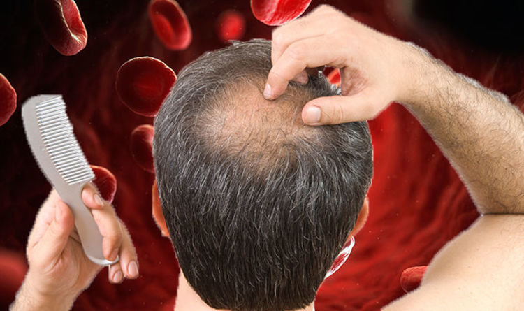 Iron Deficiency Anaemia Hair Loss Could Be A Sign Of The