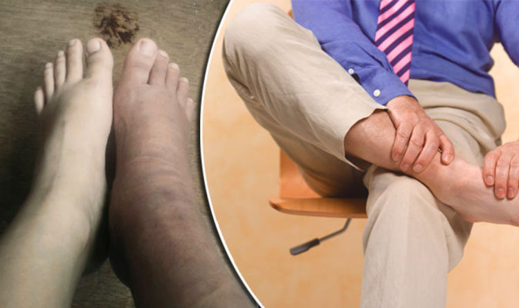 Swollen Ankles And Feet Symptoms Could Be Sign Of Heart Failure