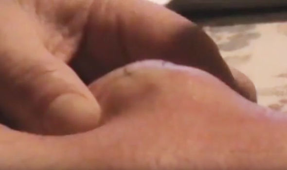 Stomach Churning Moment Golf Ball Sized Cyst Explodes From Man S