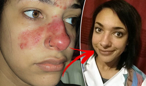 Student Nurse Finds Miracle Cream After Developing Skin Condition