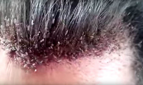 Watch Stomach Churning Video Shows Man S Hairline Crawling With