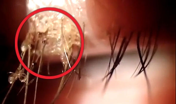 Stomach Churning Video Shows Lice Crawling In A Woman S Eyelashes