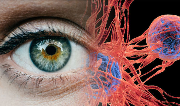 Eye Cancer Signs Watch Out For A Dark Spot On The Coloured Part