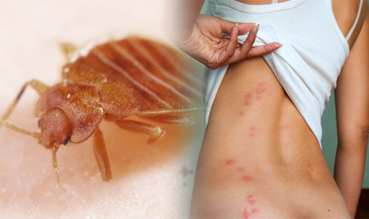 How can u tell if you have bed bug bites