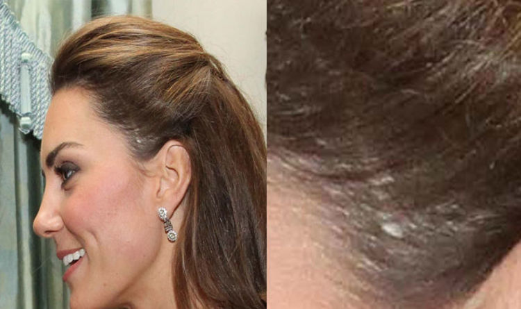 Image result for kate middleton scar