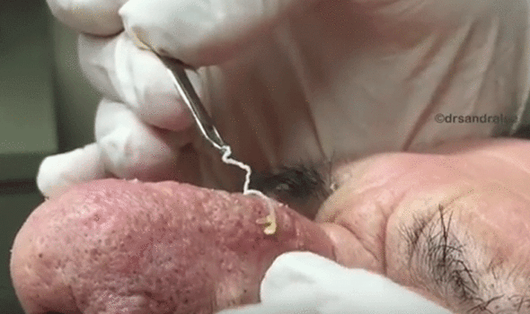 Gruesome Blackhead Popping Video From Dr Sandra Lee Express Co Uk