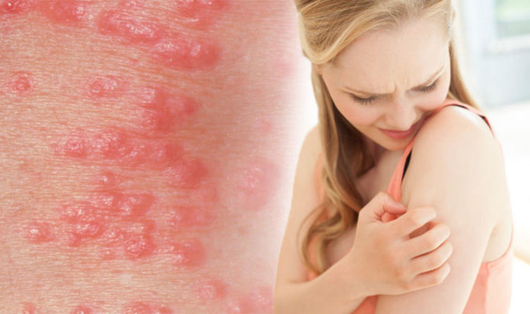 Scabies Rash Three Symptoms Of The Skin Mites And Treatment And Cream Available Express Co Uk