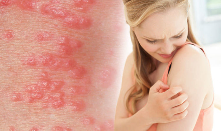 Scabies Images Rash